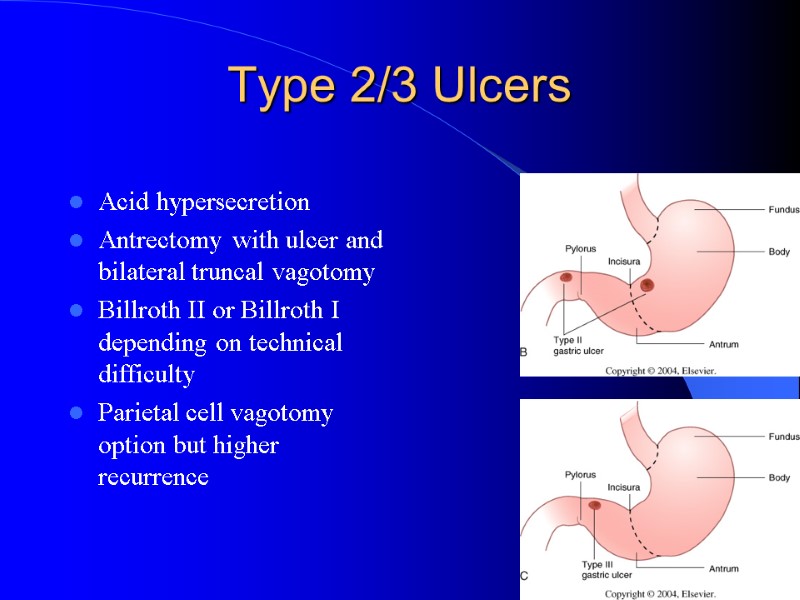 Type 2/3 Ulcers Acid hypersecretion Antrectomy with ulcer and bilateral truncal vagotomy Billroth II